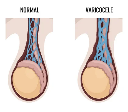 Wat is een varicocele en waarom is het gevaarlijk